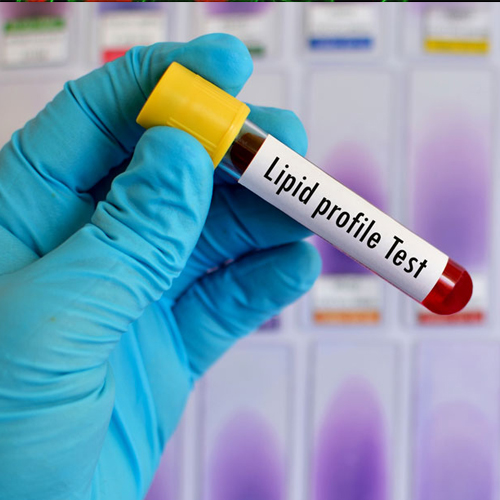 Lipid Profile